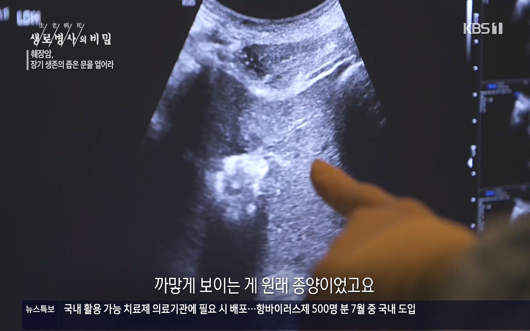 생로병사의 비밀.E823.220622p.H264-F1RST.mp4_20220624_210517.839.jpg