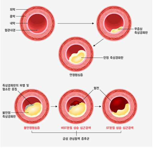 혈관 건강의 문제 사진