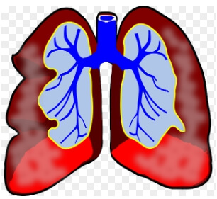 신체 기관인 폐의 폐렴 증상