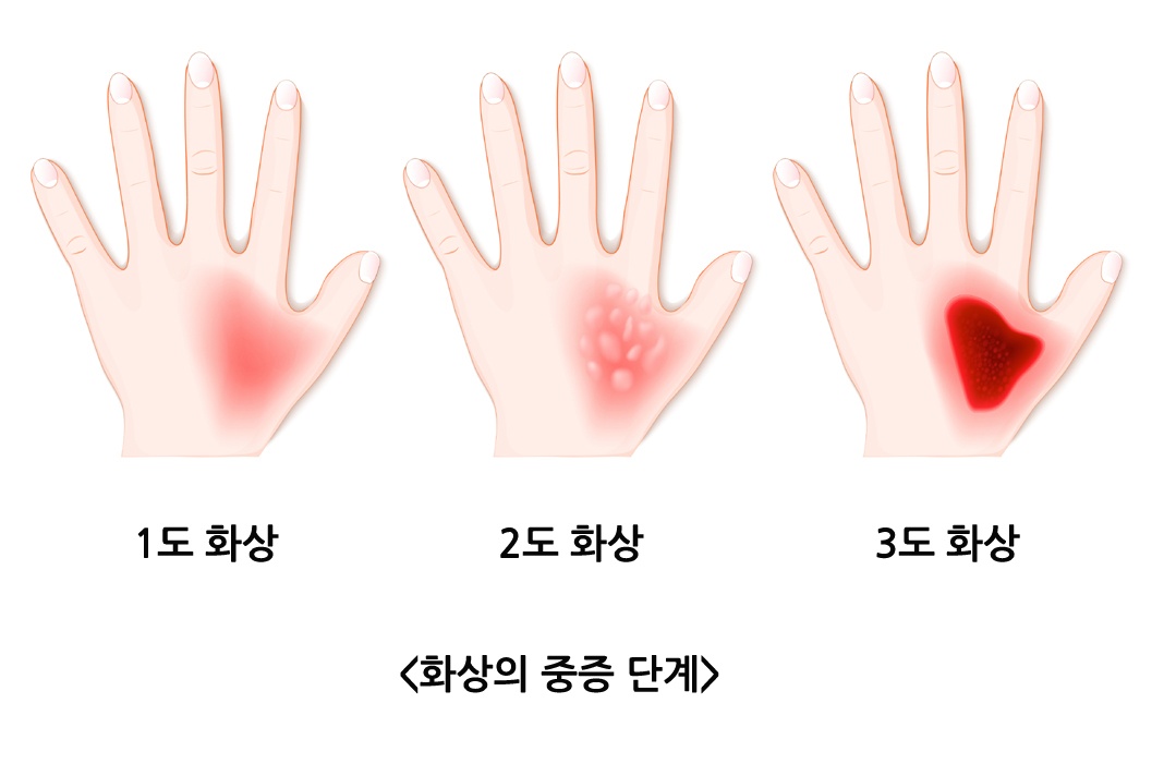 화상