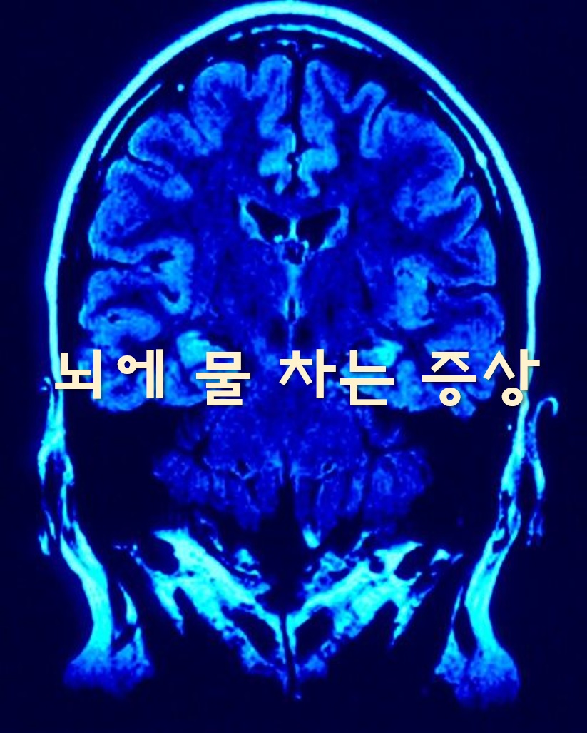  뇌에 물 차는 증상과 병의 치료 방법