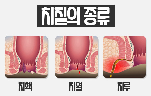 치질의 종류