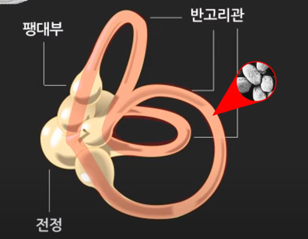 이석증 관련사진