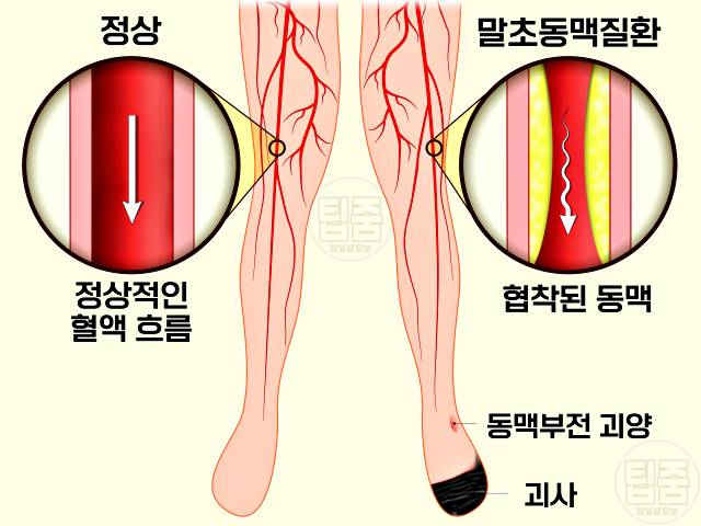 종아리 통증 원인 종아리가 땡기고 아파요 하지동맥질환