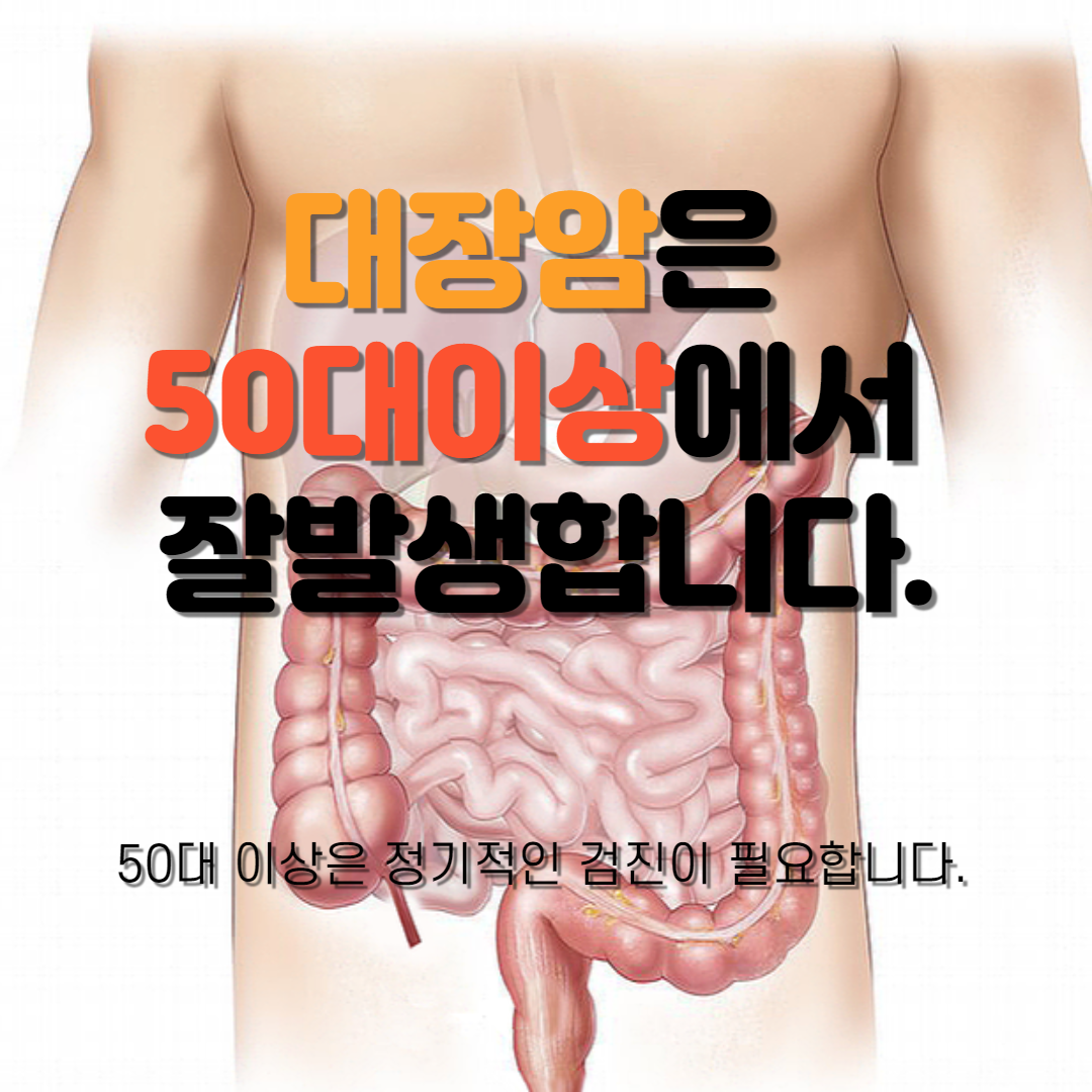  대장암은 50대 이상에서 잘 발생합니다.