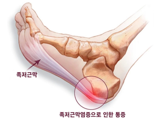 족저근막염 원인 및 치료방법