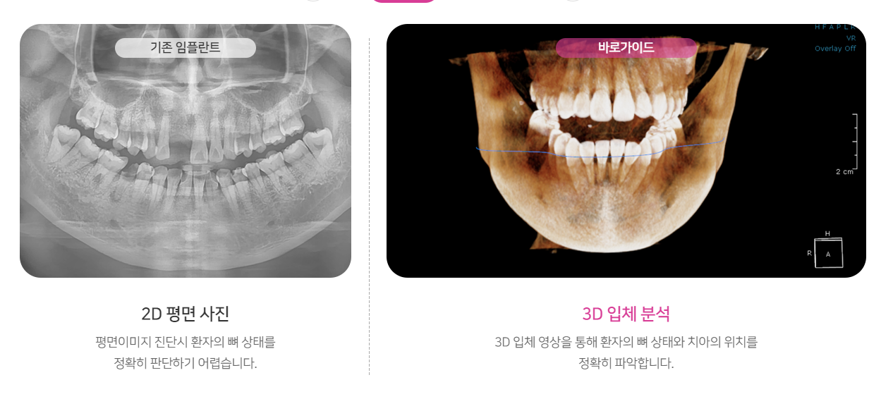 네오임플란트 시술