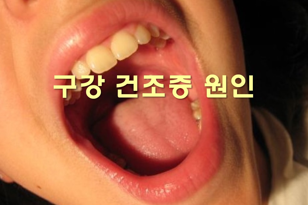  구강 건조증 원인과 구강 건조증에 좋은 음식
