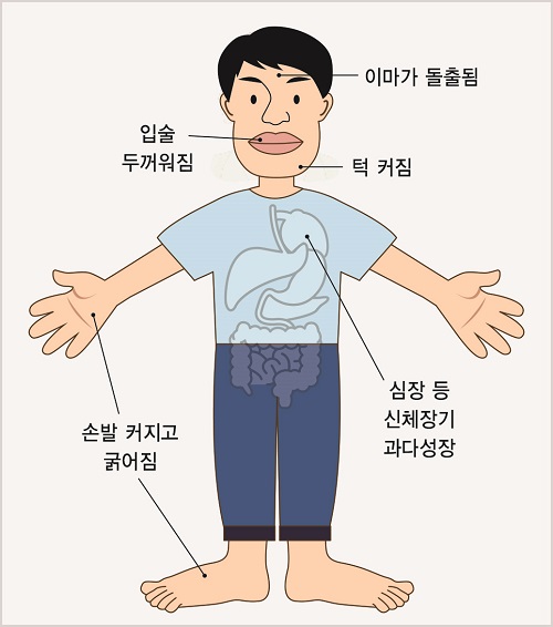 말단비대증