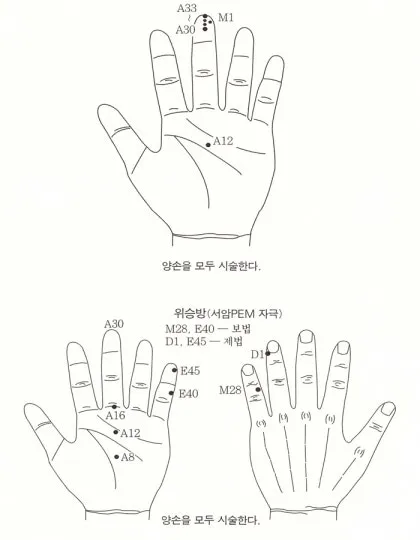 두통 수지침 편두통 혈자리_1