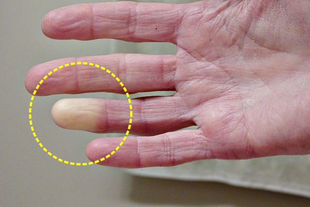 추울때 손가락 끝이 하얗게 변하는 레이노 증후군 증상 관절염 루스프