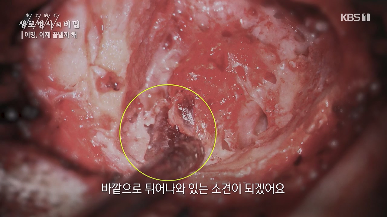 생로병사의 비밀.E883.230914p-NEXT.mp4_20230914_204618.337.jpg