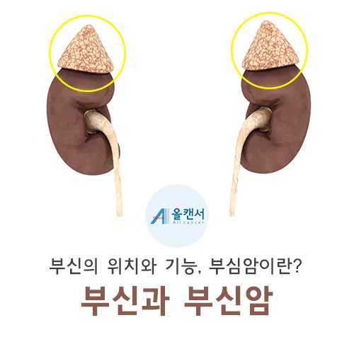 부신암 증상 치료법 예방 관리방법_7