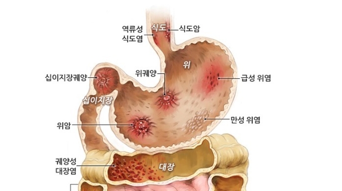 역류성 식도염 증상