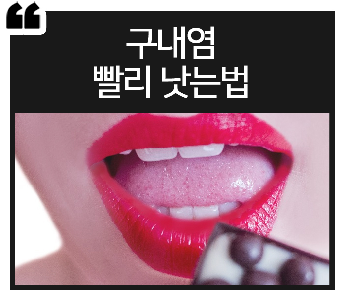  구내염 빨리 낫는법 이대로만!!!!