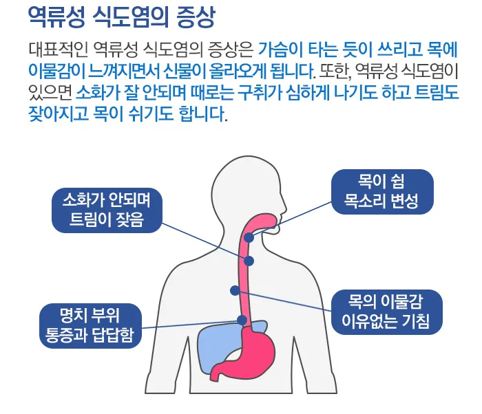 역류성 식도염 원인 초기증상 예방하는 방법_2