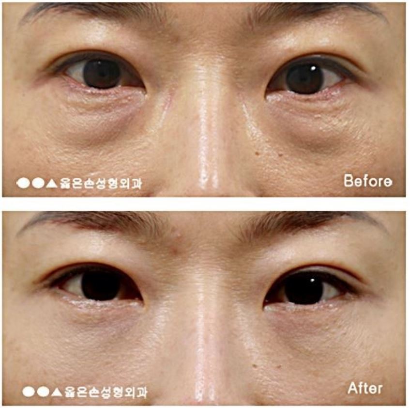 하안검 수술 부위를 신중하게 결정