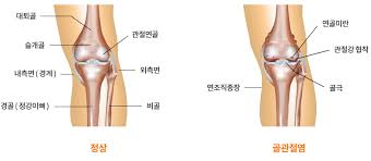 연골연화증 영양제