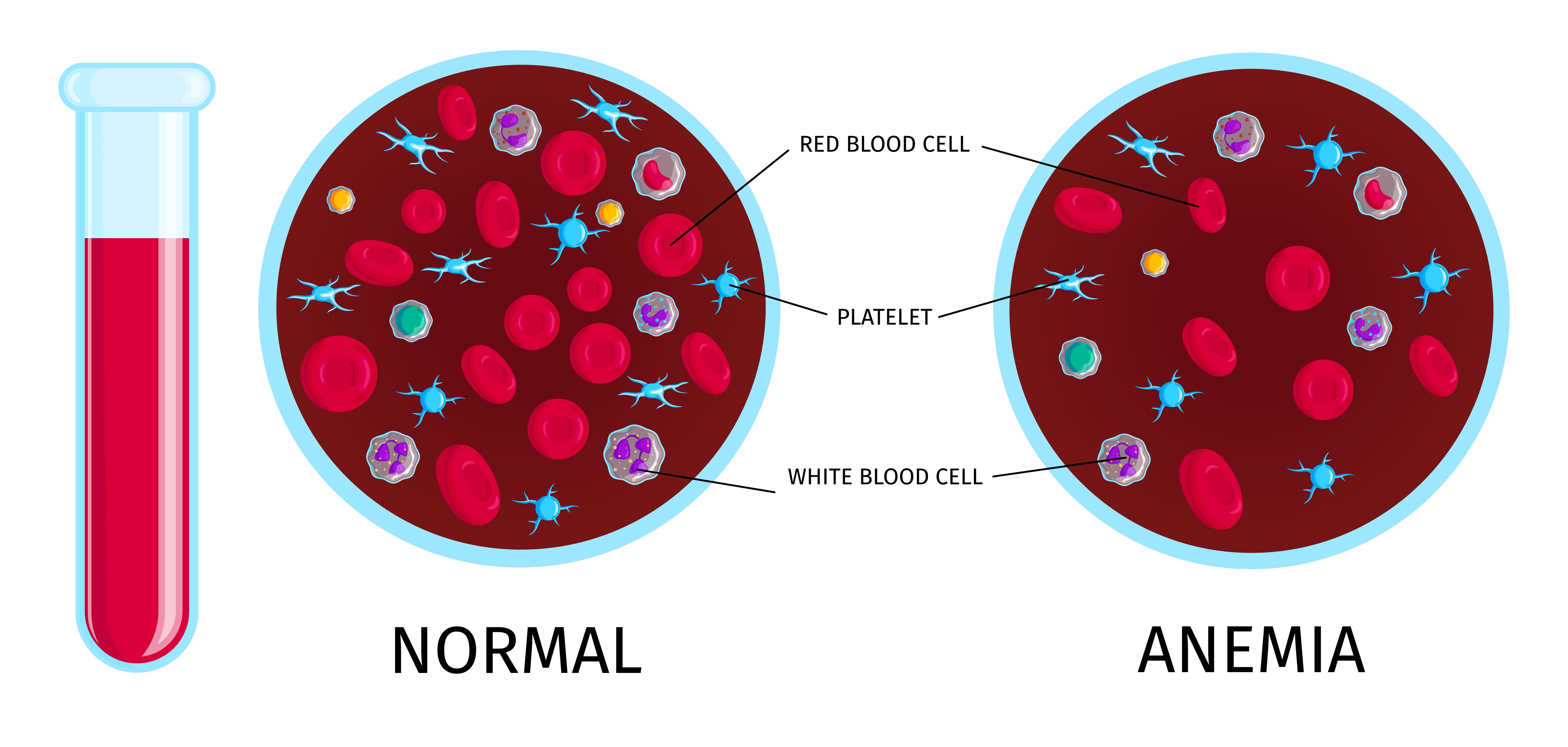 혈액검사상 빈혈을 나타내주는 이미지인데&#44; 왼쪽이 정상적인 혈액의 구성이고&#44; 오른쪽이 적혈구의 숫자가 월등히 적은 빈혈의 혈액 구성이다.