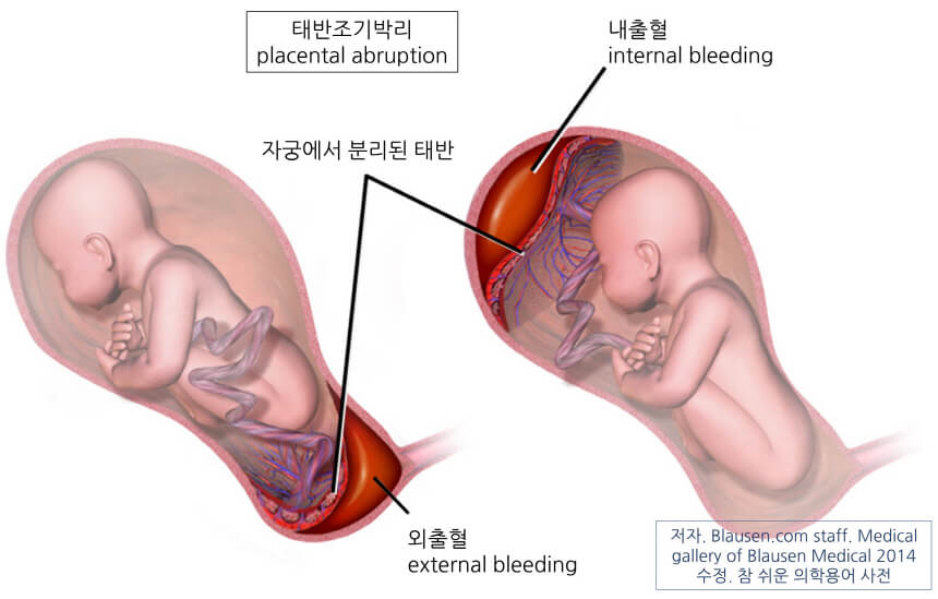 의학용어 placental abruption = abruptio placentae 뜻 태반조기박리