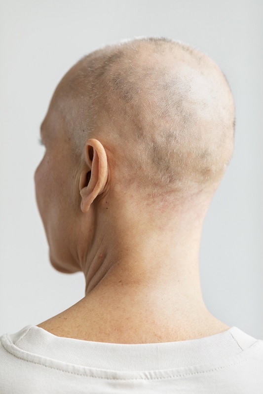 hair-loss-medicine