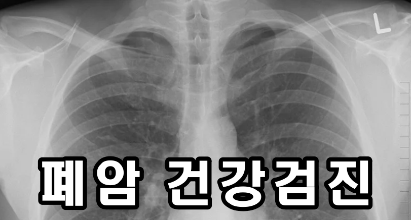 관악구 저선량 폐CT검사