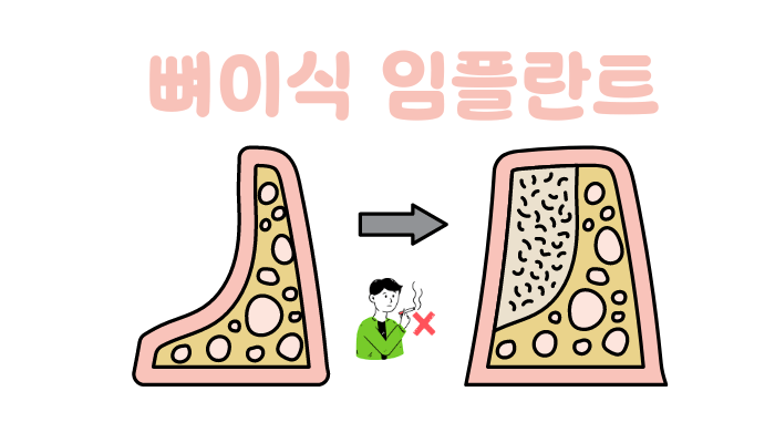 뼈이식 임플란트 수명과 성공률-흡연은 절대금물