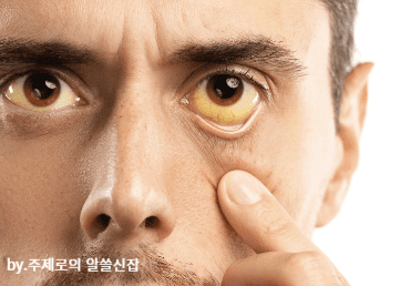황달의 증상 피부와 눈의 노란색 변화