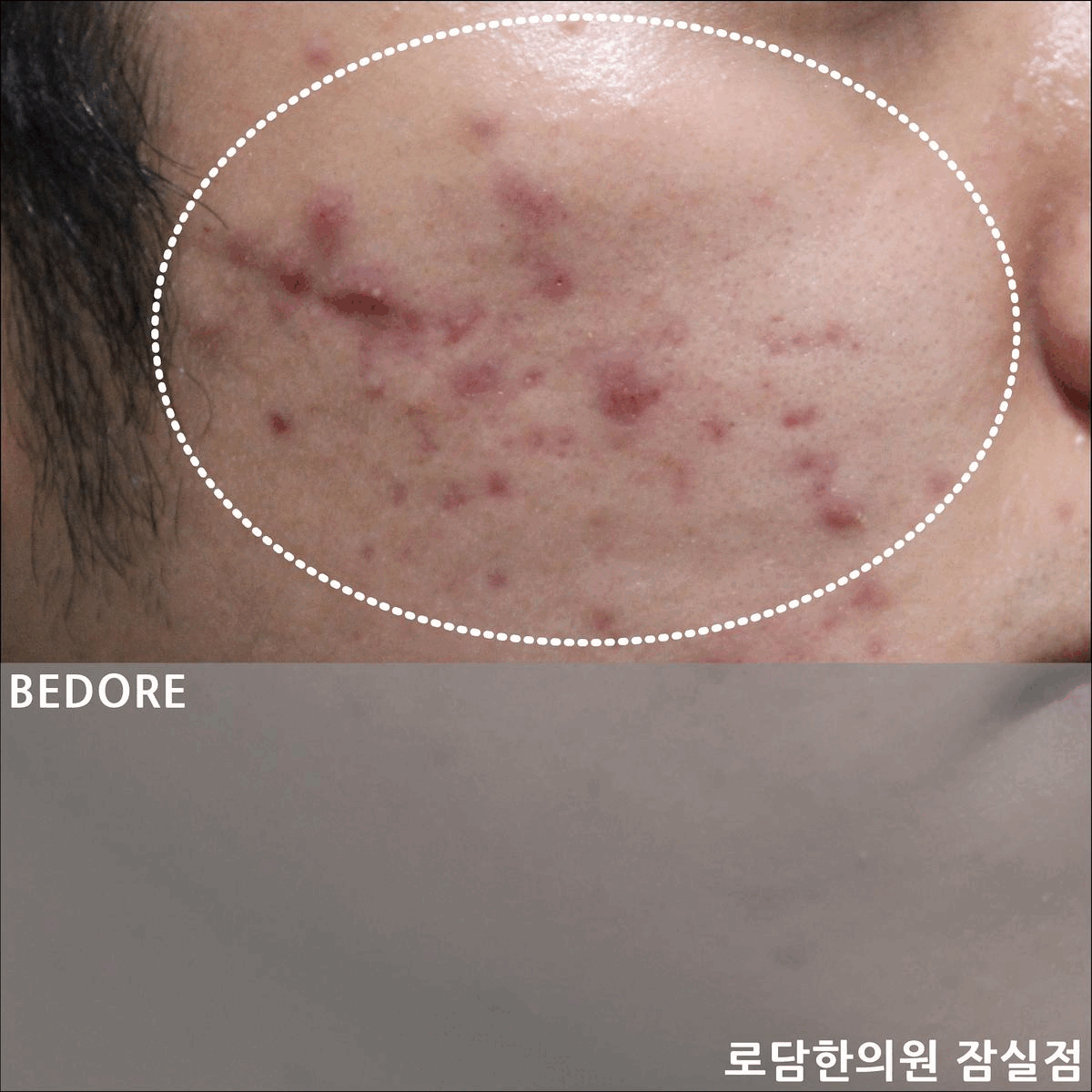  잠실 여드름 흉터 붉은 자국 치료 과정 한의원 새살침 코라테라피