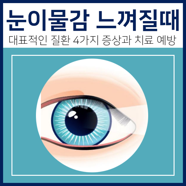 눈 이물감 느껴질 때 의심할 수 있는 질환 4가지 - 안구건조증, 백내장, 눈 대상포진, 결막염