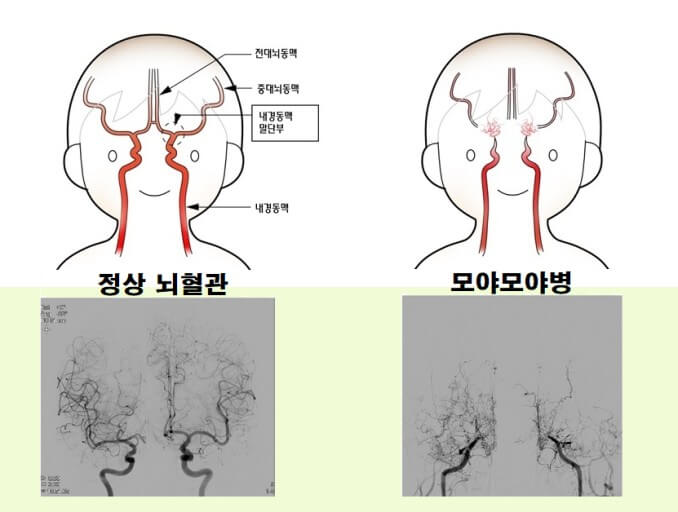 모야모야병 증상