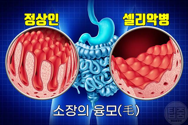 복부에 가스가 발생하는 이유 셀리악병