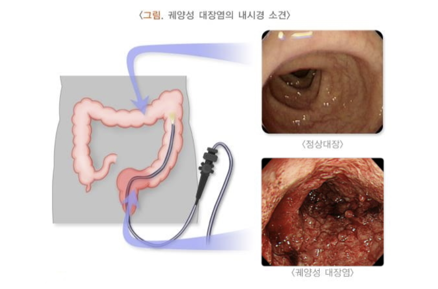 궤양성 대장염의 내시경 소견