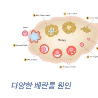 배란통 증상 및 시기 원인_12