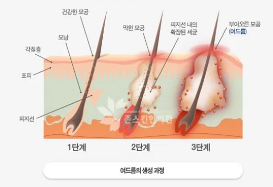 여드름 생성과정