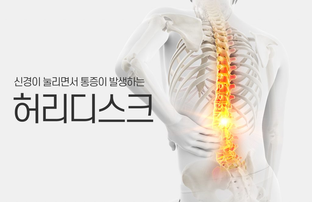  "허리디스크: 당신도 모르게 허리를 망치는 습관들, 이제는 고치자!"