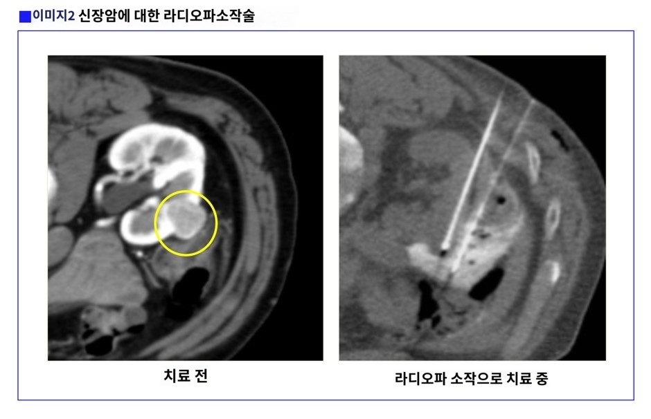 라디오파 암치료