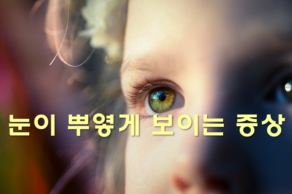  눈이 뿌옇게 보이는 증상의 원인과 개선 방법