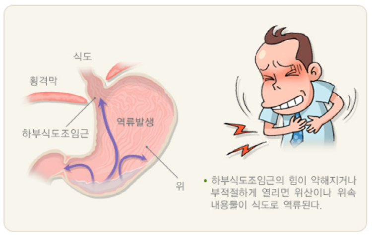 역류성식도염 증상