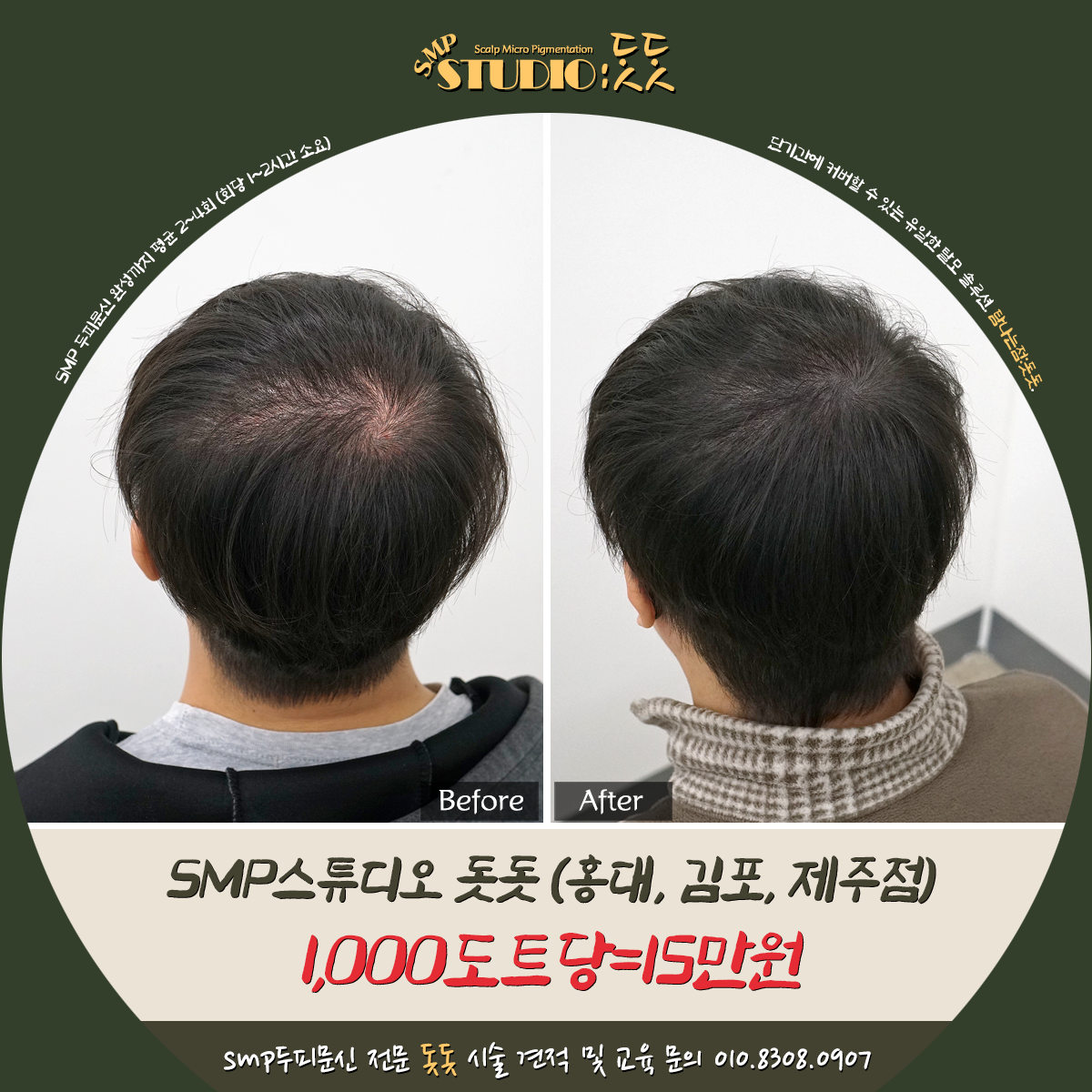  부천 두피문신 smp결과물은 작업자의 기술력에 따라 천지차이