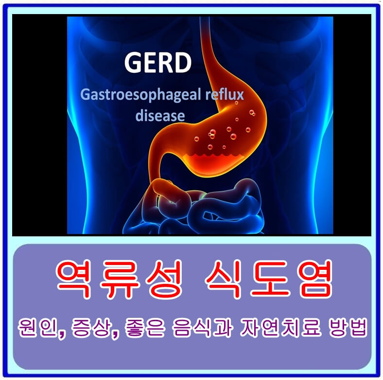  역류성 식도염의 원인, 증상, 좋은 음식과 자연치료 방법