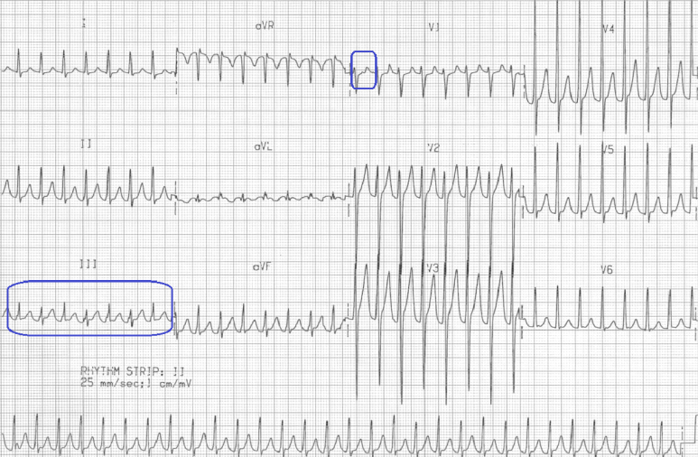Orthodromic AVRT ECG