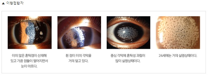 아벨리노각막증-이형접합자-눈-사진