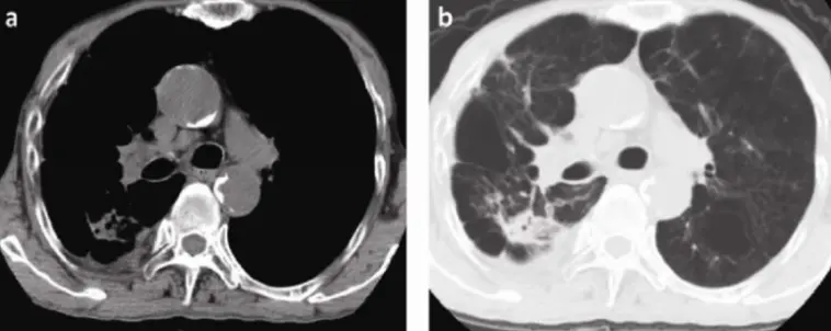 chronic necrotizing pulmonary aspergilosis
