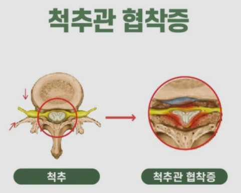 척추관협착증