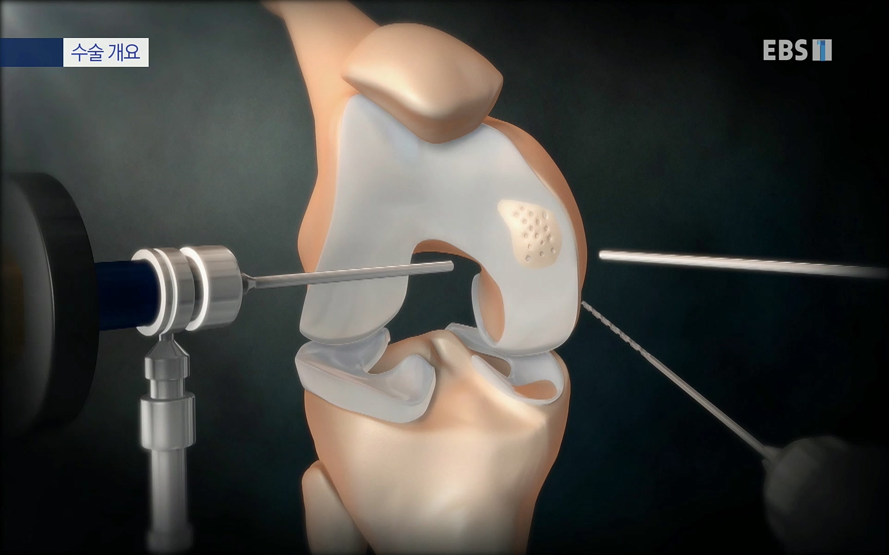 EBS 명의 헬스케어 - TV - 교육의 중심 EBS무릎 건강 프로젝트 2부 새 무릎으로 사는 법 .mp4_20220726_202343.961.jpg