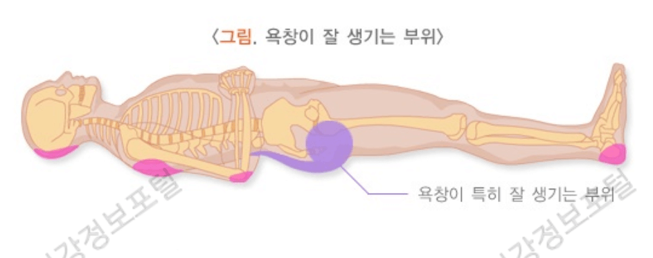 욕창