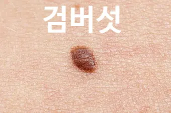 몸에 점이 계속 생기는 이유 원인부터 예방법까지 한눈에_6