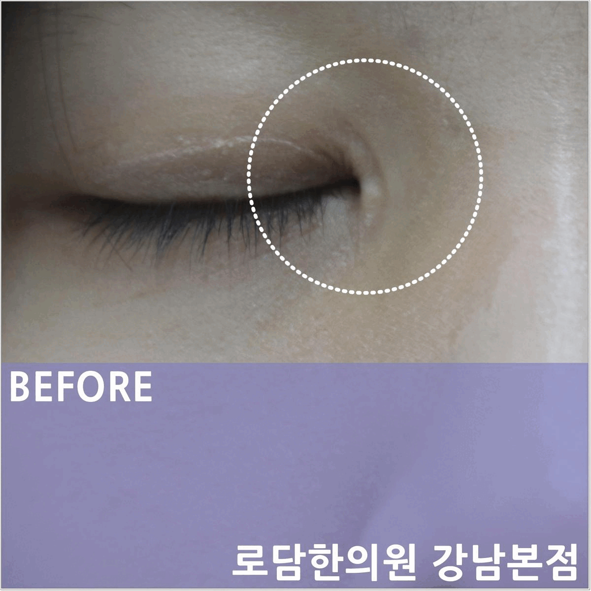  앞트임 흉터 제거 새살침 코라테라피로 복원을