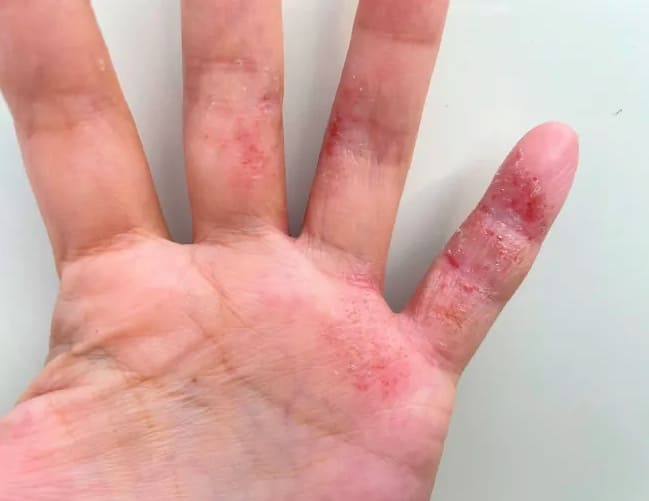 아토피-낫는법이-시급한분들이라면-주목-아토피-피부염에-좋은-음식-추천